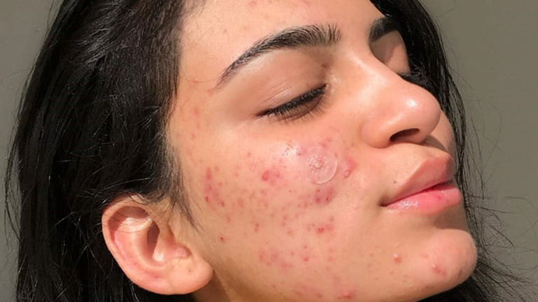 có nên đi spa trị mụn tuổi dậy thì hay không