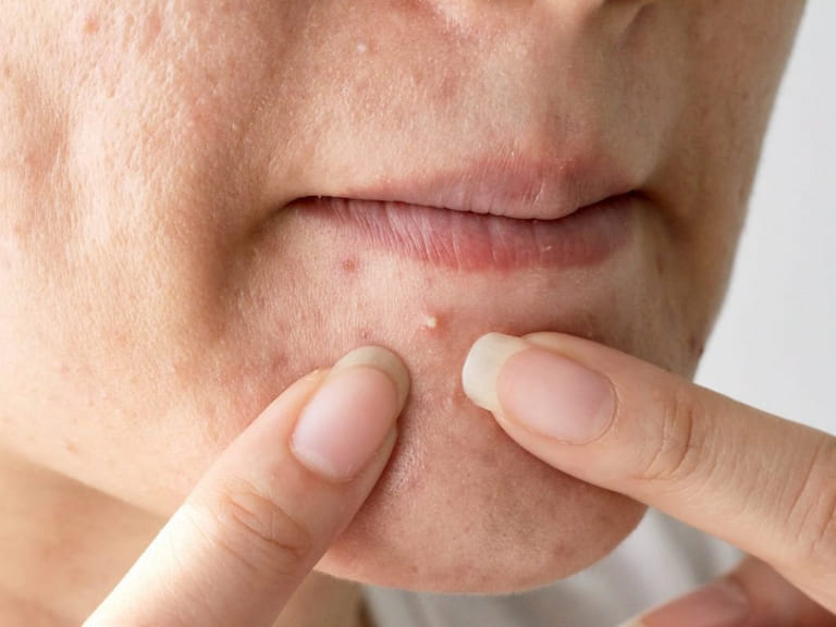 giá spa trị mụn cao không