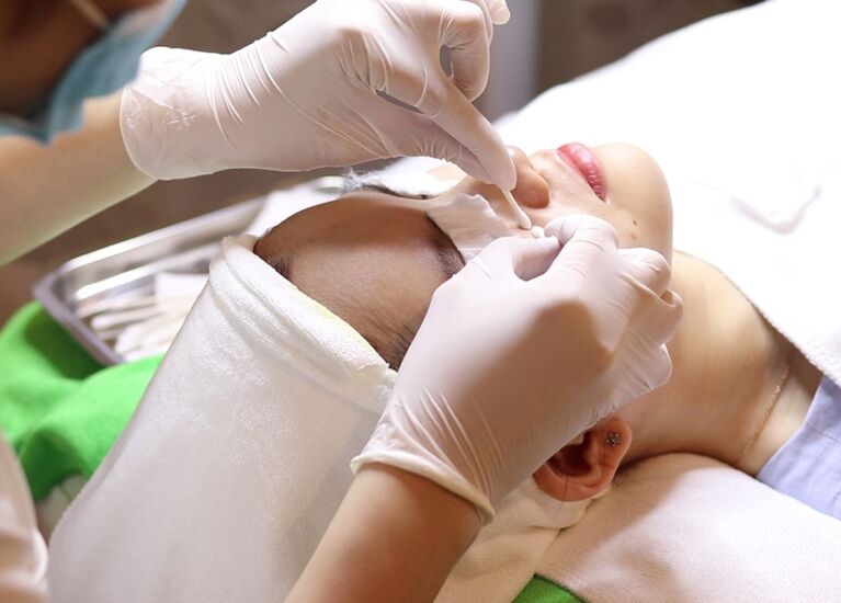 sau khi trị mụn nên làm gì