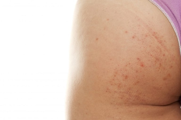 điều trị mụn mông tại spa