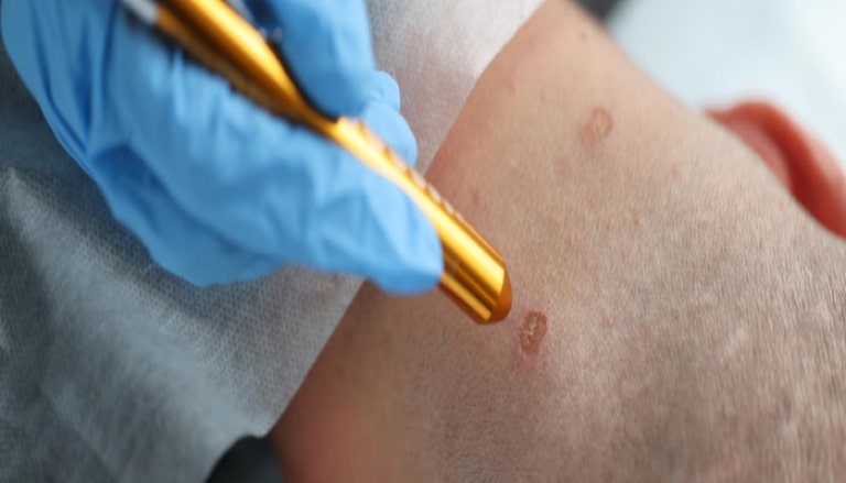 Spa trị mụn thịt uy tín đảm bảo đem lại hiệu quả cao