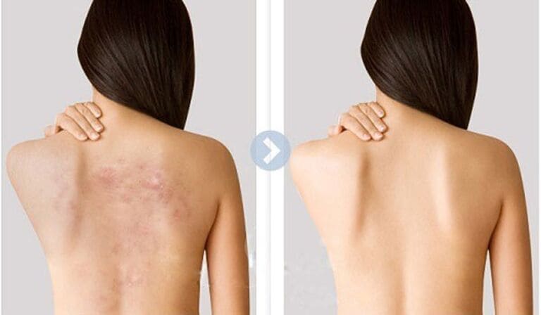 trị mụn lưng spa nào tốt