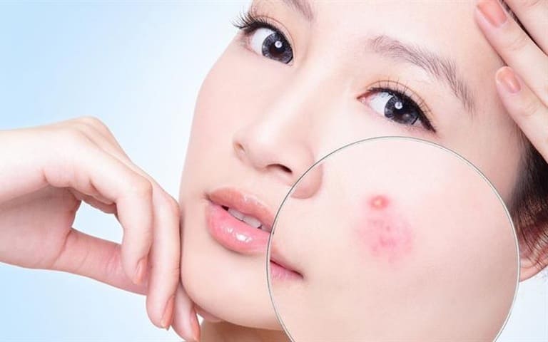 Hướng Dẫn 10 Cách Trị Mụn Nhanh Nhất Chỉ Trong 1 Ngày