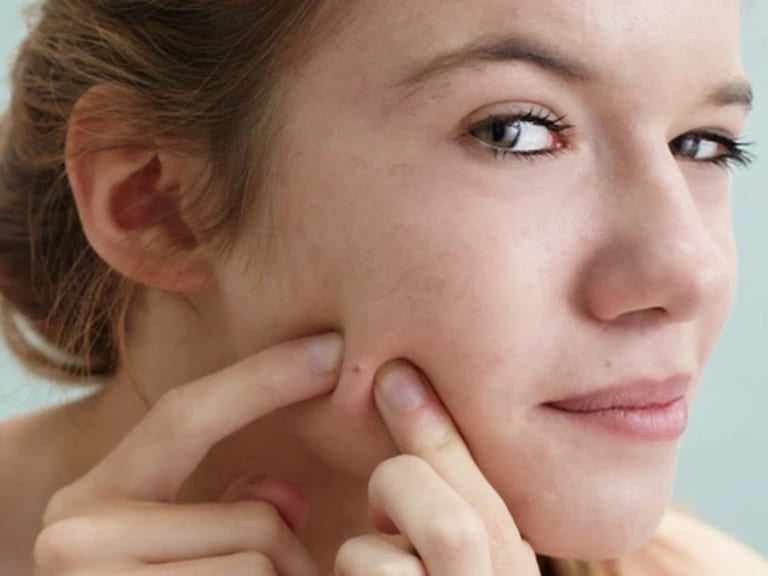 có nên nặn mụn khi đang dùng bha không