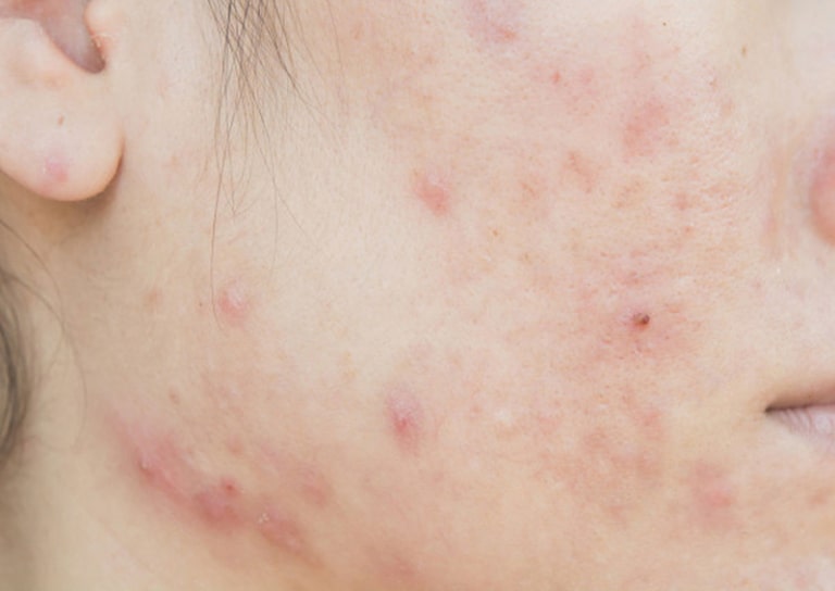 giá lấy nhân mụn tại spa