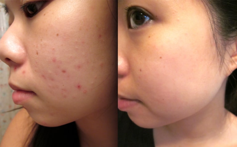 liệu trình trị mụn thâm tại spa hiệu quả