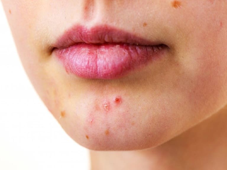 loại mụn nào không nên nặn