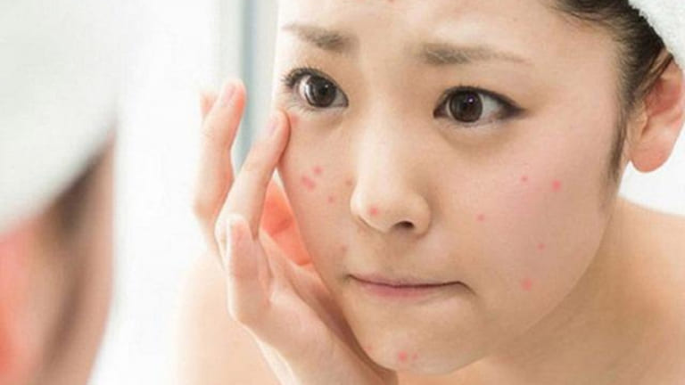 loại mụn nào nên nặn