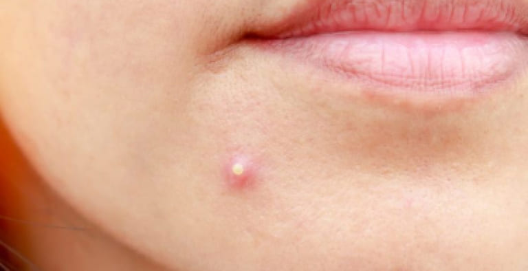 loại mụn nào nên nặn