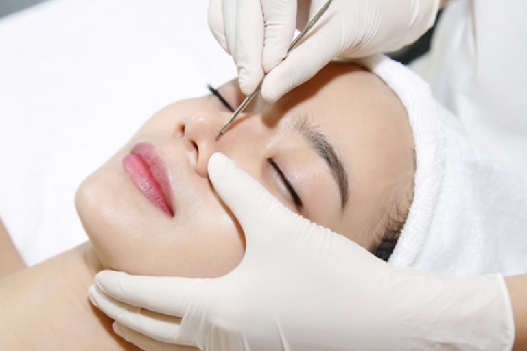 mụn viêm nên nặn hay là không