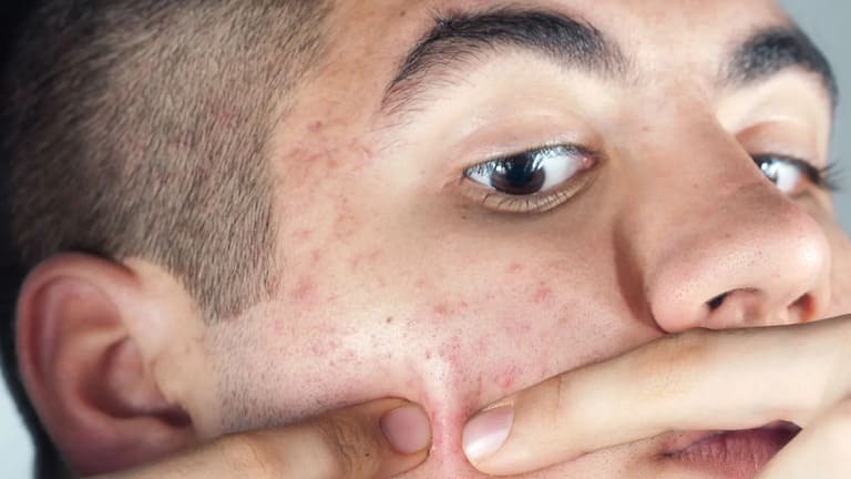 nặn mụn an toàn