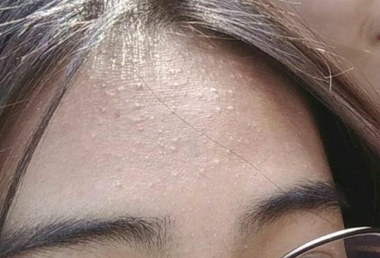 Spa trị mụn ẩn uy tín